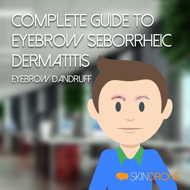 Complete Guide to Dealing with Seborrheic Dermatitis of the Eyebrows (aka Eyebrow Dandruff) Cover Photo