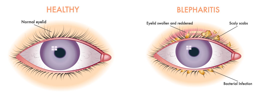 Illustration comparing a healthy eyelid to one that is affected by seborrheic dermatitis or more precisely seborrheic blepharitis.