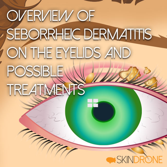 Cover Image for Overview of Seborrheic Dermatitis Treatments of the Eyelids and Possible Treatments