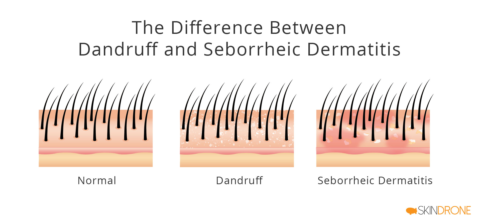 Visual representation of key differences between dandruff and seborrheic dermatitis